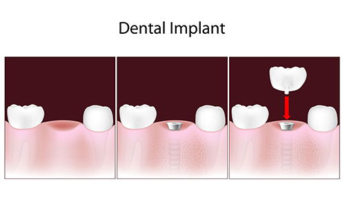 Kendall dental implants